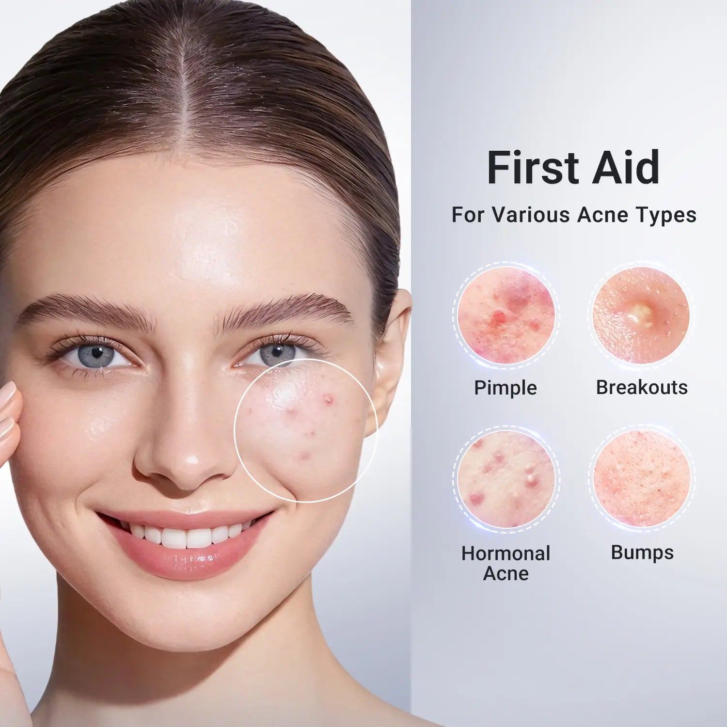 Dr.Leo Drying Lotion | Pimple Treatment & Body Acne Treatment | Visibly Shrinks Pimples in 24 Hours & Helps Fade Acne Marks in 7 Days | With 1.8%25 Encapsulated Salicylic Acid, 4%25 Niacinamide & 10%25 Sulfur (20ml) #mothersdaygift #Summervibes