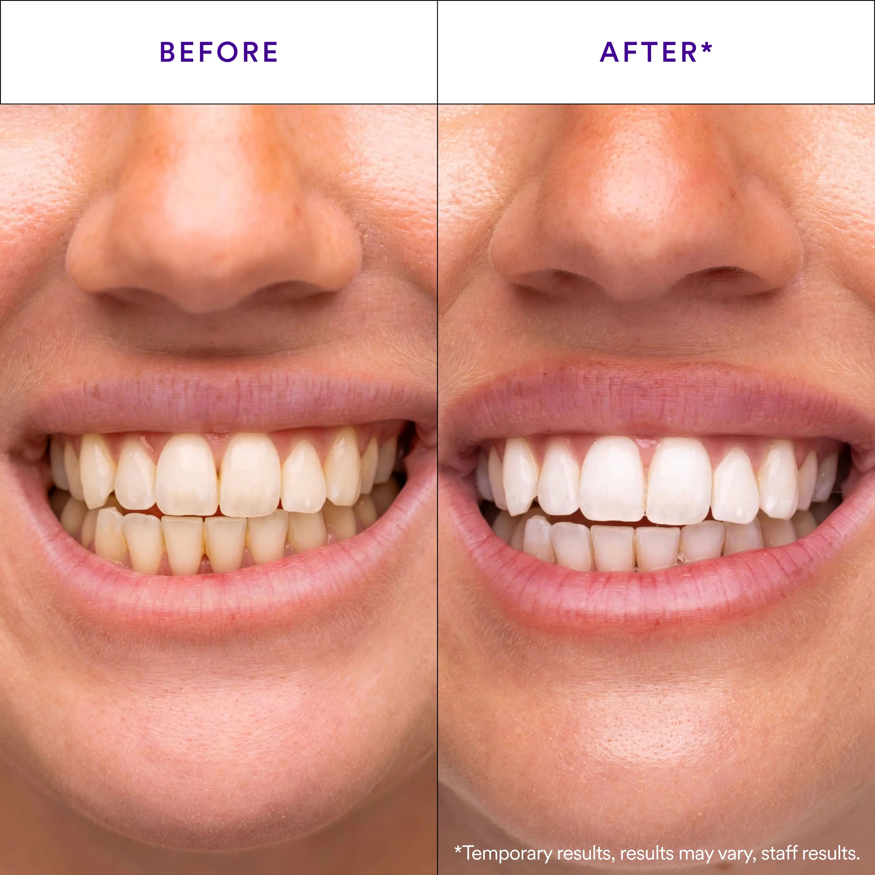Hismile V34 Whitening Strips, Teeth Whitening Strips, Purple Tooth Whitening, Combining Whitening and Colour Correction